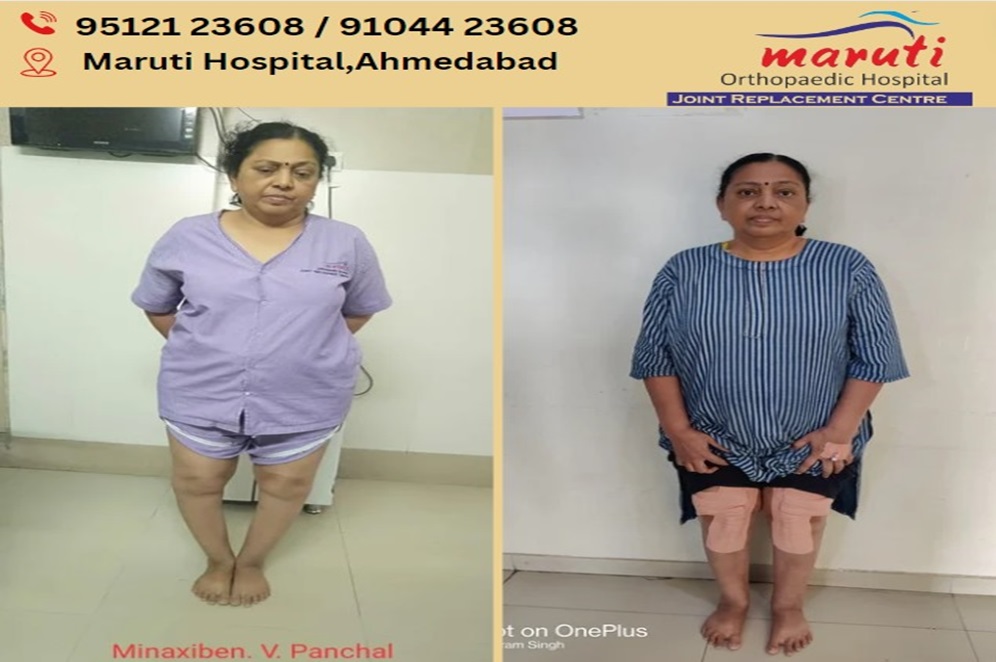 Minaxiben Panchal(Total Knee Replacement Before & after Surgery)