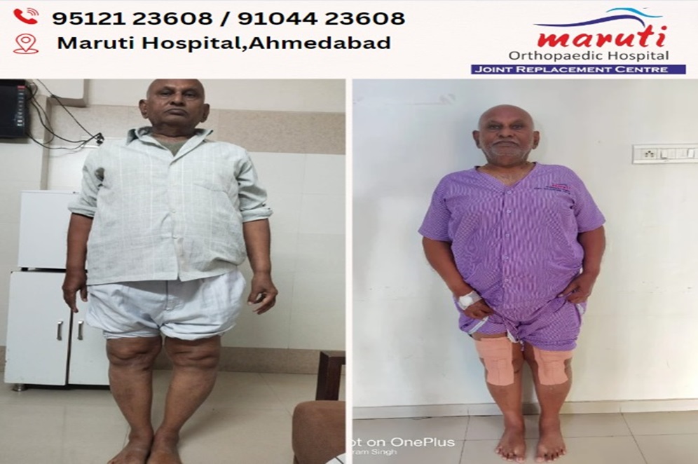 Vinodbhai Before & After Surgery