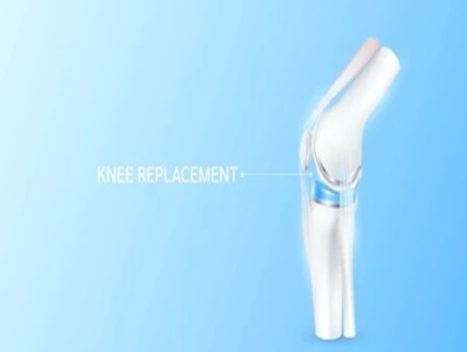 Knee Replacement