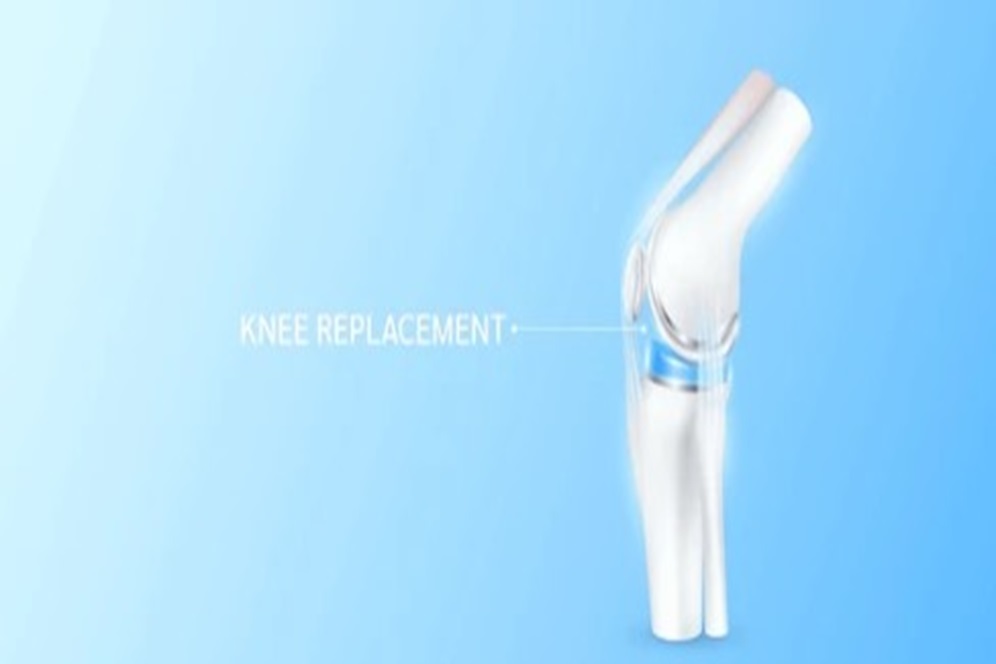 Robotic Knee Replacement