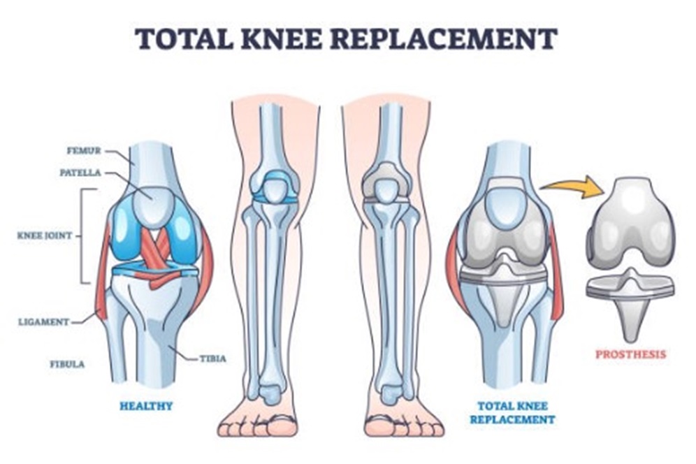 Total Knee Replacement