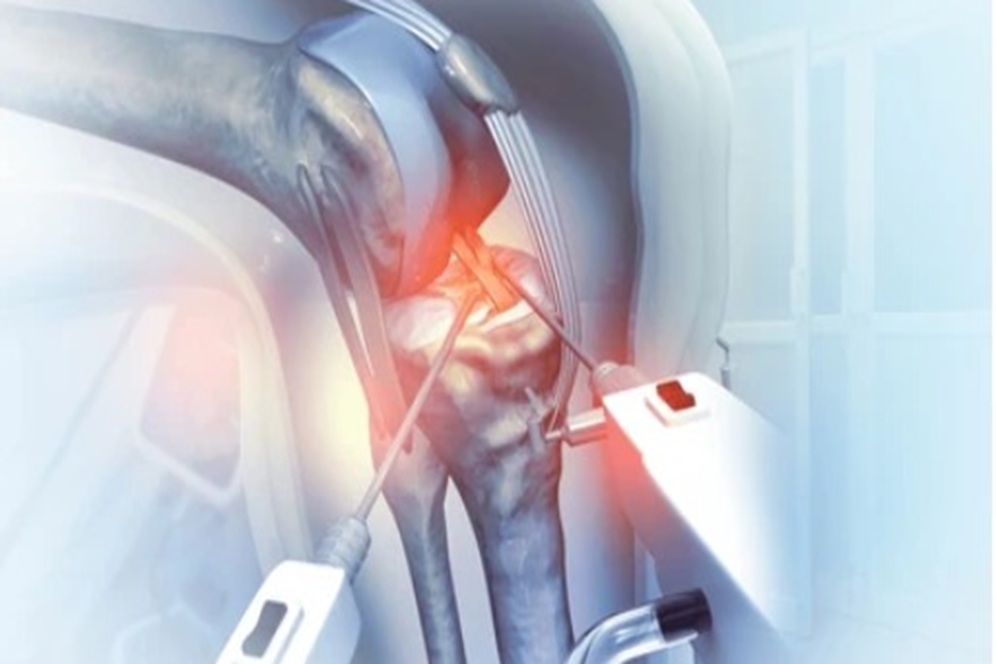 Knee Replacement Surgery