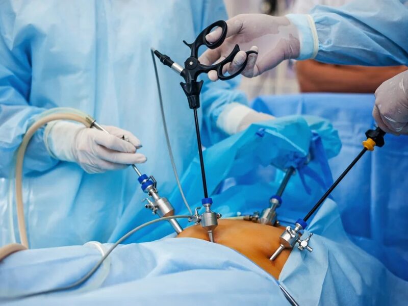 laparoscopy Surgery